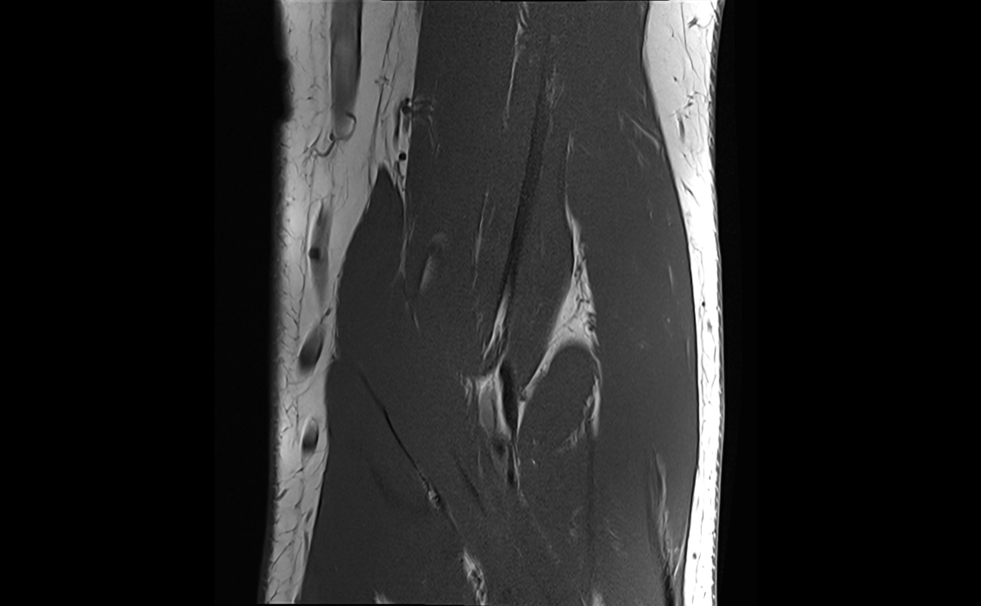 MRI elbow ligaments coronal cross sectional anatomy 3T  radiology  image-img-07001-00014.webp